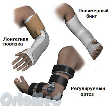 Травмы (переломы) локтевого сустава