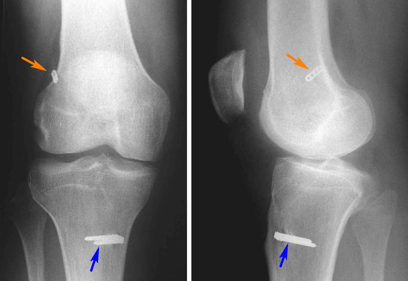Трещина связке. Гемартроз коленного сустава рентген. Перелом мениска рентген. Мениск коленного сустава рентген. Артропластика ПКС коленного сустава.