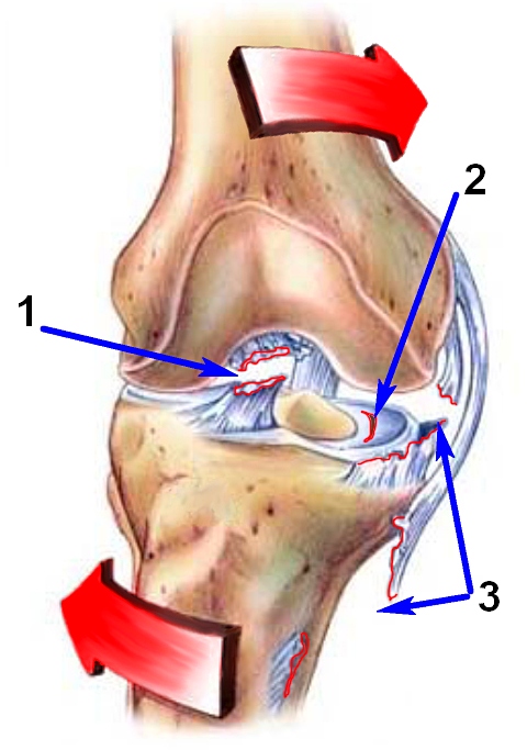 Травма колена, растяжение связок – причины