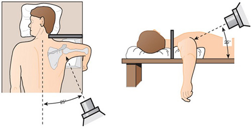 Восстановительное лечение плечевого сустава после операции латарже тесты с ответами нмо